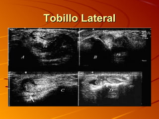 Tobillo LateralTobillo Lateral
 