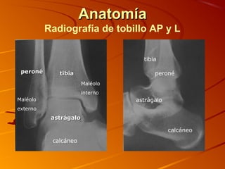 AnatomíaAnatomía
Radiografía de tobillo AP y L
tibiatibiaperonéperoné peroné
tibia
calcáneo
astrágaloastrágalo
astrágalo
calcáneo
Maléolo
externo
Maléolo
interno
 