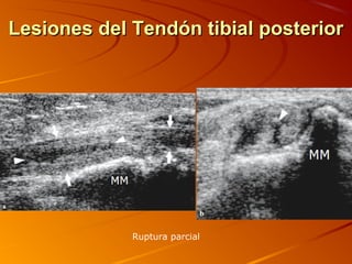 Lesiones del Tendón tibial posteriorLesiones del Tendón tibial posterior
Ruptura parcial
 