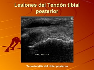 Lesiones del Tendón tibialLesiones del Tendón tibial
posteriorposterior
Tenosinivitis del tibial posterior
 