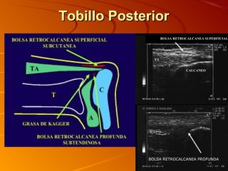 Tobillo PosteriorTobillo Posterior
BOLSA RETROCALCANEA PROFUNDA
 