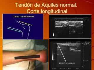Tendón de Aquiles normal.
Corte longitudinal
 
