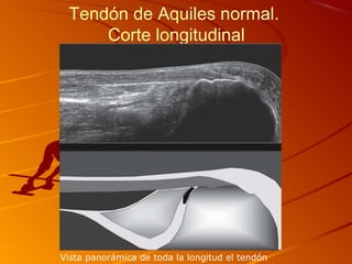 Tendón de Aquiles normal.
Corte longitudinal
Vista panorámica de toda la longitud el tendón
 