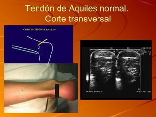 Tendón de Aquiles normal.
Corte transversal
 
