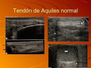 Tendón de Aquiles normal
 