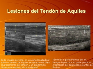 Lesiones del Tendón de AquilesLesiones del Tendón de Aquiles
En la imagen derecha, en un corte longitudinal
sobre el tendón de Aquiles se aprecia una claro
engrosamiento del tendón y un predominio
hipoecoico respecto al contralateral.
Tendinitis y paratendinitis del TA
Imagen hipoecoica en parte posterior ;
inflamación del paratendón (puntas de
flecha)
 