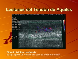 Lesiones del Tendón de AquilesLesiones del Tendón de Aquiles
Chronic Achilles tendinosis
using Doppler US vessels are seen to enter the tendon
 