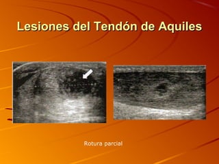 Lesiones del Tendón de AquilesLesiones del Tendón de Aquiles
Rotura parcial
 