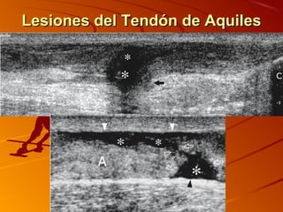 Lesiones del Tendón de AquilesLesiones del Tendón de Aquiles
 