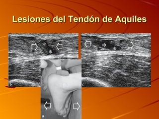 Lesiones del Tendón de AquilesLesiones del Tendón de Aquiles
 