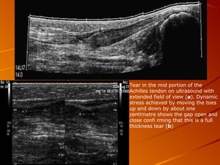Tear in the mid portion of the
Achilles tendon on ultrasound with
extended field of view (a). Dynamic
stress achieved by moving the toes
up and down by about one
centimetre shows the gap open and
close confi rming that this is a full
thickness tear (b)
 