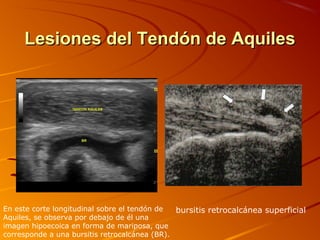 Lesiones del Tendón de AquilesLesiones del Tendón de Aquiles
En este corte longitudinal sobre el tendón de
Aquiles, se observa por debajo de él una
imagen hipoecoica en forma de mariposa, que
corresponde a una bursitis retrocalcánea (BR).
bursitis retrocalcánea superficial
 
