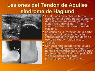 Lesiones del Tendón de AquilesLesiones del Tendón de Aquiles
síndrome de Haglundsíndrome de Haglund
En algunos pacientes se forma unEn algunos pacientes se forma un
espolón en el borde posterosuperiorespolón en el borde posterosuperior
del calcáneo que puede pinzar ladel calcáneo que puede pinzar la
superficie anterior del TA. Estesuperficie anterior del TA. Este
cuadro se denomina síndrome decuadro se denomina síndrome de
Haglund.Haglund.
La causa es la irritación de la parteLa causa es la irritación de la parte
posterior del calcáneo y de lasposterior del calcáneo y de las
estructuras que le rodean debido alestructuras que le rodean debido al
uso de calzado rígido sin taco.uso de calzado rígido sin taco.
TalalgiaTalalgia
Con ecografía puede verse líquidoCon ecografía puede verse líquido
en el triángulo graso de Kager yen el triángulo graso de Kager y
bursitis retrocalcánea; puede haberbursitis retrocalcánea; puede haber
engrosamiento local de la piel, TCSengrosamiento local de la piel, TCS
y del TA cerca del bordey del TA cerca del borde
posterosuperior del calcáneo.posterosuperior del calcáneo.
 