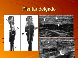 Plantar delgadoPlantar delgado
 