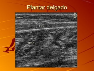 Plantar delgadoPlantar delgado
 