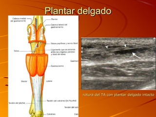 Plantar delgadoPlantar delgado
rotura del TA con plantar delgado intactorotura del TA con plantar delgado intacto
 