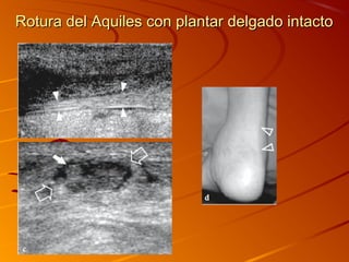 Rotura del Aquiles con plantar delgado intactoRotura del Aquiles con plantar delgado intacto
 
