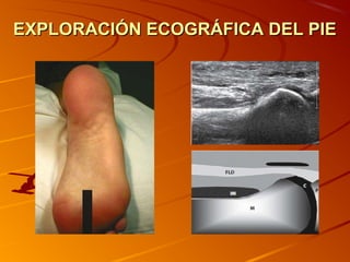 EXPLORACIÓN ECOGRÁFICA DEL PIEEXPLORACIÓN ECOGRÁFICA DEL PIE
 