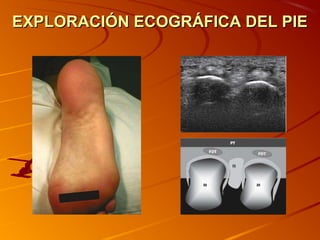 EXPLORACIÓN ECOGRÁFICA DEL PIEEXPLORACIÓN ECOGRÁFICA DEL PIE
 