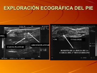 EXPLORACIÓN ECOGRÁFICA DEL PIEEXPLORACIÓN ECOGRÁFICA DEL PIE
 