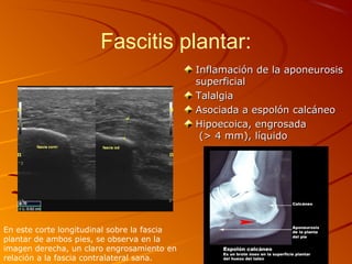Fascitis plantar:
Inflamación de la aponeurosisInflamación de la aponeurosis
superficialsuperficial
TalalgiaTalalgia
Asociada a espolón calcáneoAsociada a espolón calcáneo
Hipoecoica, engrosadaHipoecoica, engrosada
(> 4 mm), líquido(> 4 mm), líquido
En este corte longitudinal sobre la fascia
plantar de ambos pies, se observa en la
imagen derecha, un claro engrosamiento en
relación a la fascia contralateral sana.
 