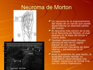 Neuroma de Morton
Un neuroma es el engrosamiento
del tejido de un nervio que puede
desarrollarse en distintas partes
del cuerpo.
El neuroma mas común en el pie
es el Neuroma de Morton, el cual
aparece en la base del tercer y
cuarto dedo.
También denominado fibrosis
perineural del nervio digital
plantar es una causa
relativamente frecuente de dolor
intenso y parestesias en el
antepie.
Ante la sospecha de esta lesión, la
ecografía puede facilitar su
diagnóstico observándose una
imagen hipoecoica de forma oval
con un centro hiperecoico.
 