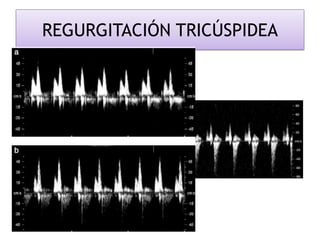 REGURGITACIÓN TRICÚSPIDEA
 