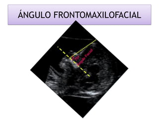 ÁNGULO FRONTOMAXILOFACIAL
 