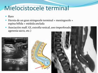Mielocistocele terminal
 Raro
 Hernia de un gran siringocele terminal + meningocele +
espina bífida + médula anclada
 Asociación malf. GI, extrofia vesical, ano imperforado,
agenesia sacra, etc.)
 