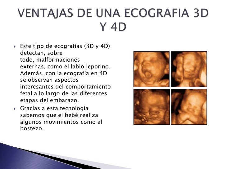Ecografías 3 d y 4d Ecografías 3 d y 4d