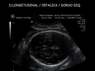 1) LONGITUDINAL / CEFALICA / DORSO IZQ 