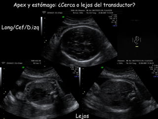Apex y estómago: ¿Cerca o lejos del transductor? Lejos Long/Cef/D.izq 