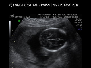 2) LONGITUDINAL / PODALICA / DORSO DER 