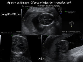 Apex y estómago: ¿Cerca o lejos del transductor? Long/Pod/D.der Lejos 