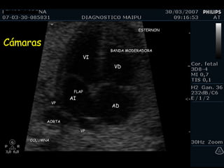 Cámaras COLUMNA AORTA ESTERNON VP VP BANDA MODERADORA FLAP VI VD AI AD 