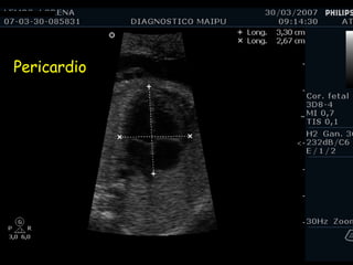 Pericardio 