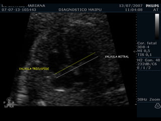 VALVULA MITRAL VALVULA TRICUSPIDE 