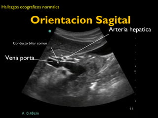 Orientacion Sagital 
Conducto biliar comun 
Vena porta 
Arteria hepatica 
Hallazgos ecograficos normales 
 