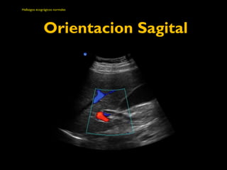 Hallazgos ecográgicos normales 
Orientacion Sagital 
 