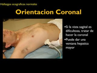 Hallazgos ecograficos normales 
Orientacion Coronal 
•Si la vista sagital es 
dificultosa, tratar de 
hacer la coronal 
•Puede dar una 
ventana hepatica 
mayor 
 
