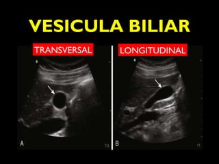 VESICULA BILIAR 
TRANSVERSAL LONGITUDINAL 
 