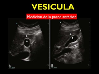 VESICULA 
MeBdiciIónL deI Ala paRred anterior 
 