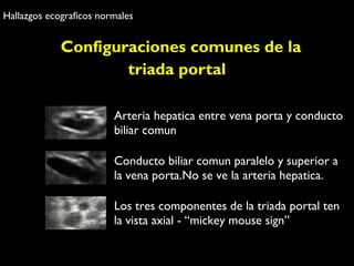 Hallazgos ecograficos normales 
Configuraciones comunes de la 
triada portal 
Arteria hepatica entre vena porta y conducto 
biliar comun 
Conducto biliar comun paralelo y superior a 
la vena porta.No se ve la arteria hepatica. 
Los tres componentes de la triada portal ten 
la vista axial - “mickey mouse sign” 
 