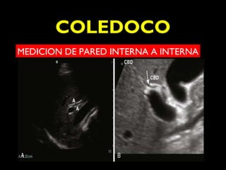 COLEDOCO 
MEDICION DE PARED INTERNA A INTERNA 
 