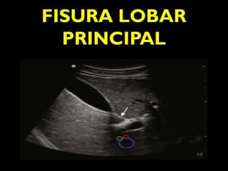FISURA LOBAR 
PRINCIPAL 
 