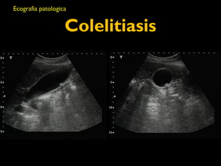 Ecografia patologica 
Colelitiasis 
 