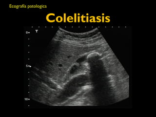 Ecografía patologica 
Colelitiasis 
 