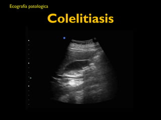 Ecografía patologica 
Colelitiasis 
 