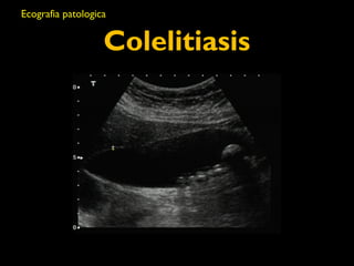 Ecografia patologica 
Colelitiasis 
 