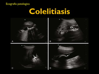 Ecografia patologica 
Colelitiasis 
 